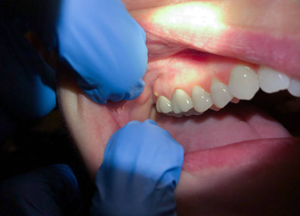 Best Emergency Dental Care for Sports Injuries in Hagaman, NY
